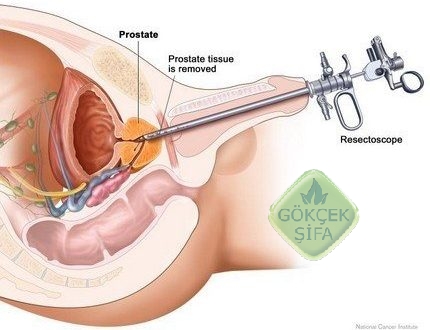 Prostatın alınması sonrası