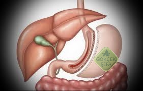 seleeve-gastrektomi-komplikasyonlari